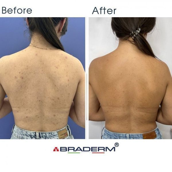 СПРЕЙ-КОНЦЕНТРАТ ДЛЯ ТІЛА З БЕНЗОЇЛ ПЕРОКСИДОМ BRADERM DORSAK SPRAY BRADERM8 фото